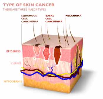 Skin Cancer Types: Melanoma,Squamous Cell Carcinoma and Basal Cell ...