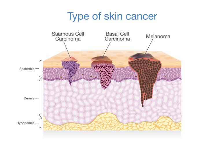 Appearance Of Skin Cancer Types