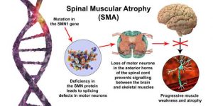 Spinal Muscle Atrophy: Is There a Cure?